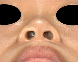 下から　手術前　プロテ＋鼻尖縮小(3D法)＋鼻翼縮小(内側・flap法)