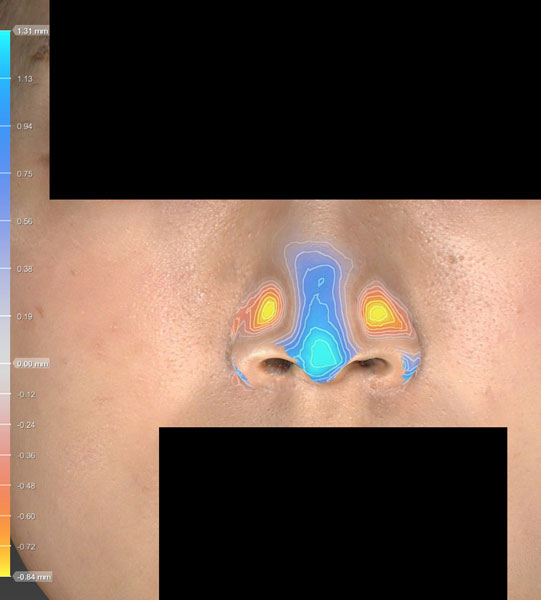 正面　色変化　鼻尖縮小(3D法)＋軟骨移植
