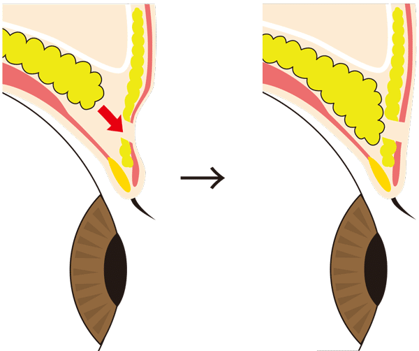 眼窩脂肪を引き下げてくぼみ目を改善させる図