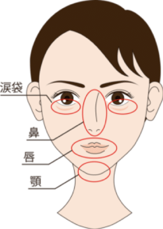 ヒアルロン酸注入部位（涙袋、鼻、唇、アゴ）