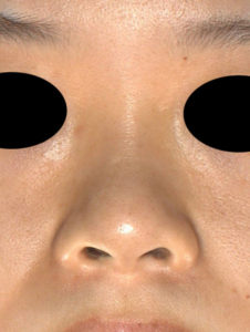 正面　手術前　プロテ＋鼻尖縮小(3D法)＋鼻翼縮小(内側・flap法)