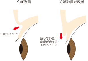 くぼみ目を改善した時の図