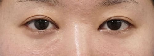 切らないタレ目、目尻切開 3ヶ月後のAfterの写真