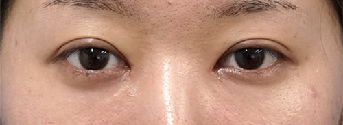 切らないタレ目、目尻切開 3ヶ月後のBefore写真