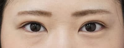 全切開＋眼瞼下垂（挙筋前転術）　半年後のAfter写真