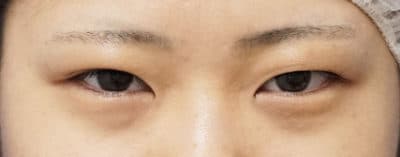 鼻尖縮小＋軟骨移植＋ストラット、鼻翼縮小（内＋外）　３ヶ月後　正面のBefore写真