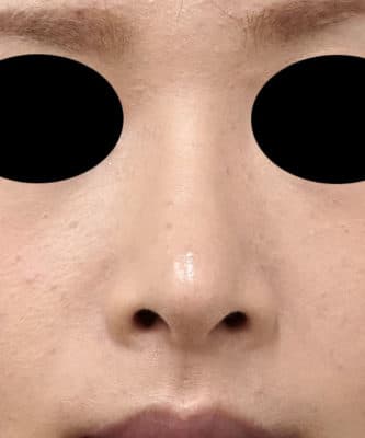 鼻尖縮小（3D法）、軟骨移植　半年後のAfter写真