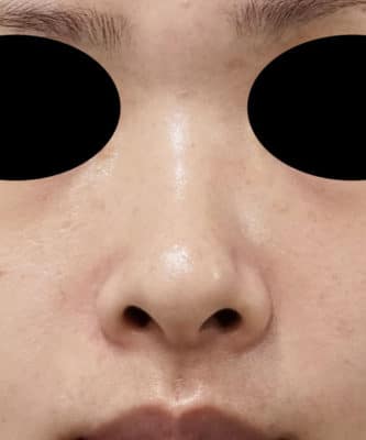 鼻尖縮小＋軟骨移植＋ストラット、鼻翼縮小（内＋外）　３ヶ月後　正面のBefore写真