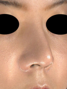 右斜め　1ヶ月後　鼻尖縮小(3D法)＋軟骨移植＋プロテーゼ