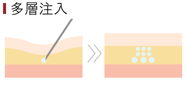 多層注入のイメージ図　若返り中カテゴリー