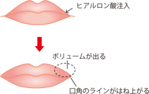 唇にヒアルロン酸を注入するイメージ