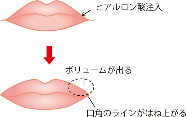 口角を上げるためのヒアルロン酸注入施術