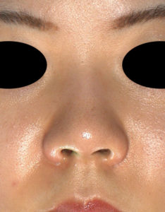 正面　手術前　後鼻尖縮小(3D法)＋軟骨移植＋プロテーゼ