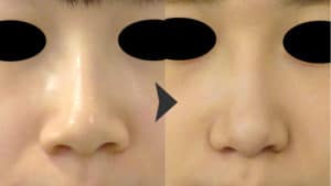 鼻翼縮小（内側法、フラップ法）の症例写真