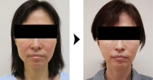 フェイスリフト（ホホ）の症例写真