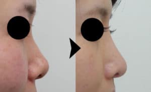 鼻中隔延長の症例写真
