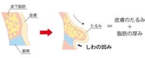 たるみを改善さえる方法