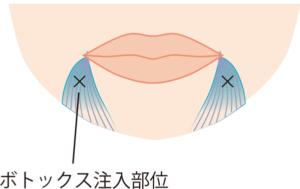 ボトックス注入部位の説明