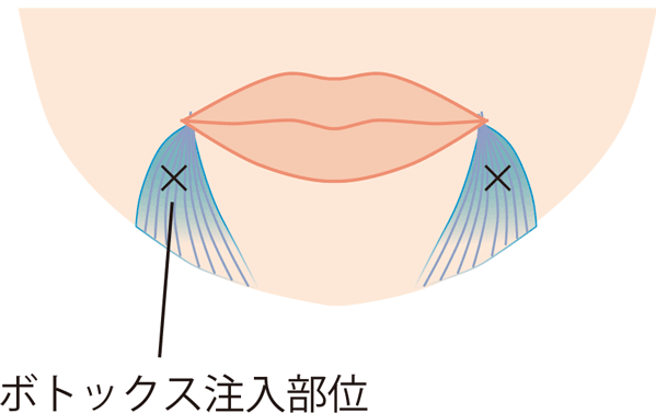 口角下制筋ボトックス。口角を上げる