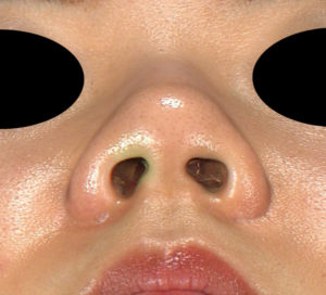 下から　手術前　鼻尖縮小(3D法)＋軟骨移植＋プロテーゼ