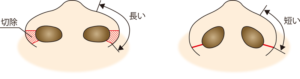 鼻翼縮小（外側法）のイメージ