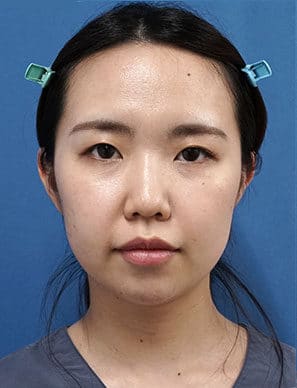 鼻尖縮小＋軟骨移植＋ストラット、鼻翼縮小（内＋外）　３ヶ月後　正面のBefore写真
