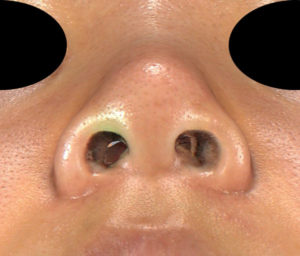 下から　手術前　鼻尖縮小(3D法)＋軟骨移植、ストラット