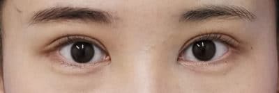 二重全切開 3ヶ月後のAfterの写真