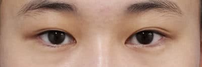 二重全切開 3ヶ月後のBefore写真