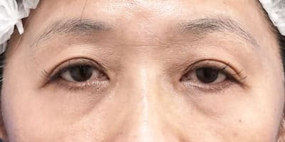 切らない眼瞼下垂　3ヶ月後のBefore写真