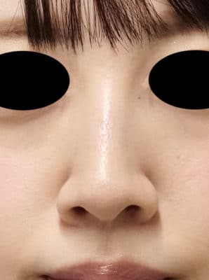 鼻翼縮小（内側法、フラップ法）　6ヶ月後のAfterの写真