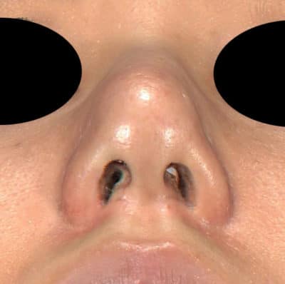 鼻尖縮小（3D法）、軟骨移植（ストラット）　3ヶ月後のAfterの写真