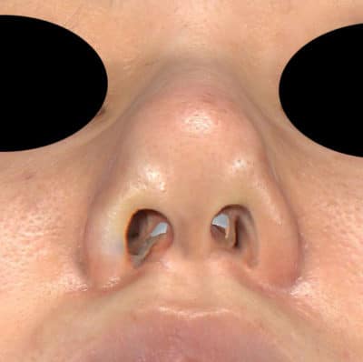 鼻尖縮小（3D法）、軟骨移植（ストラット）　3ヶ月後のBefore写真