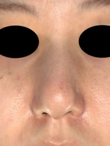 術前　正面　鼻尖縮小(3D法)