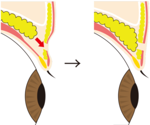 眼窩脂肪を引き下げてくぼみ目を改善