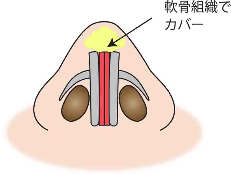 鼻尖縮小（3D法）軟部組織でカバー