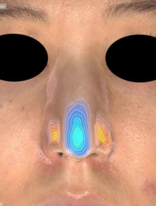 正面色による変化　鼻尖縮小(3D法)
