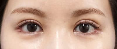 全切開、眼瞼下垂（挙筋前転）　直後～1ヶ月後のAfter写真