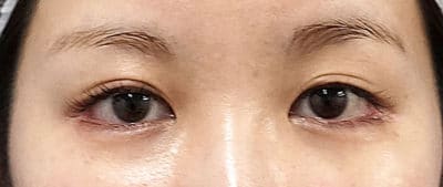 鼻尖縮小＋軟骨移植＋ストラット、鼻翼縮小（内＋外）　３ヶ月後　正面のBefore写真