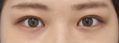 スマートバランス　３ヶ月後、閉眼ものAfter写真