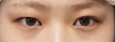 鼻尖縮小＋軟骨移植＋ストラット、鼻翼縮小（内＋外）　３ヶ月後　正面のBefore写真
