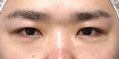 スマートバランス（二重埋没法）、下眼瞼下制　６ヶ月後のBefore写真