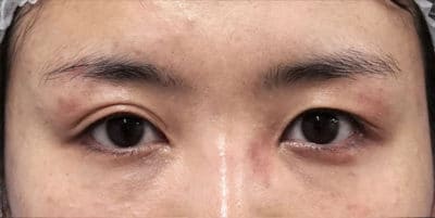 眉下切開　手術直後のBefore写真