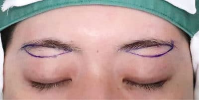 鼻尖縮小＋軟骨移植＋ストラット、鼻翼縮小（内＋外）　３ヶ月後　正面のBefore写真