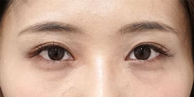 目頭切開(Z形成) 半年後のAfterの写真