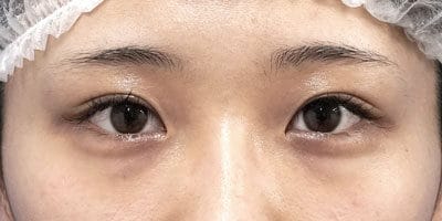 目頭切開(Z形成) 半年後のBefore写真
