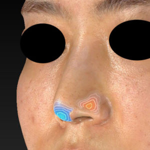 鼻尖縮小（3D法）、軟骨移植,-トビセミチル--(20180319211646297)-20190913200302193