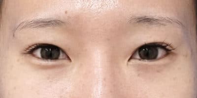 切らない眼瞼下垂プレミアム、目尻切開　半年後のAfterの写真