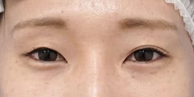 切らない眼瞼下垂プレミアム、目尻切開　半年後のBefore写真