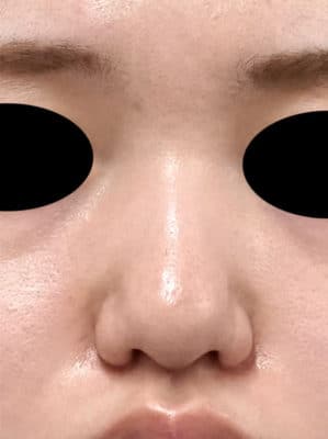 鼻尖縮小（３Ｄ法）、軟骨移植　半年後のBefore写真